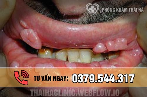 Hình ảnh bệnh sùi mào gà ở môi 2