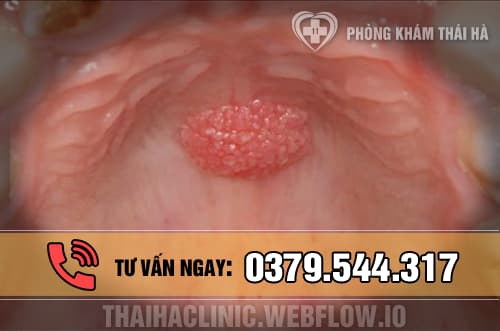Hình ảnh bệnh sùi mào gà ở vòng họng 1