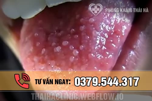 Hình ảnh bệnh sùi mào gà ở lưỡi 2