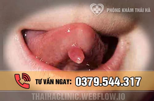 Hình ảnh bệnh sùi mào gà ở lưỡi 1