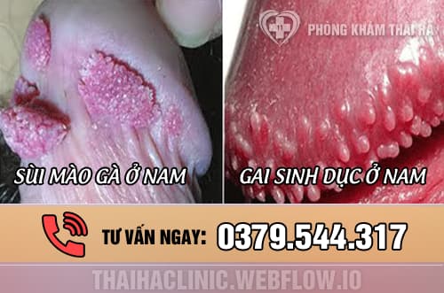 Hình ảnh phân biệt gai sinh dục và sùi mào gà ở nam giới
