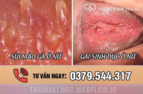Hình ảnh phân biệt gai sinh dục và sùi mào gà ở nữ giới