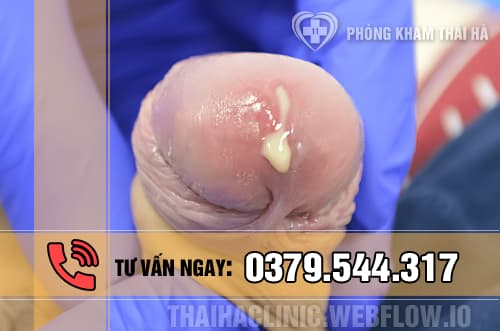 Hình ảnh viêm niệu đạo do lậu ở nam giới
