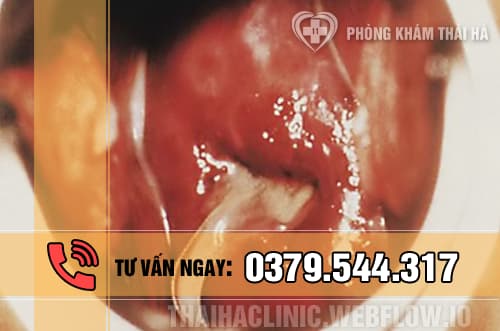 Hình ảnh viêm niệu đạo do lậu ở nữ giới