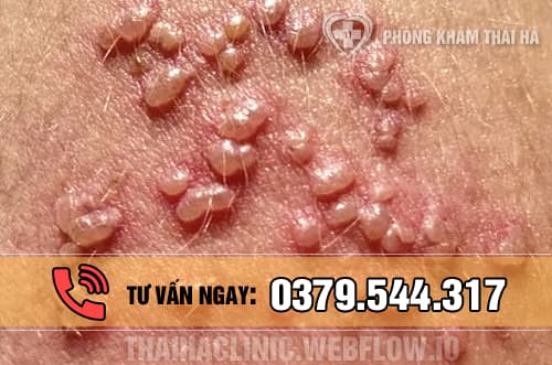 Mụn rộp sinh dục