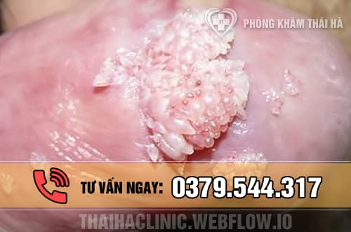 Bệnh sùi mào gà