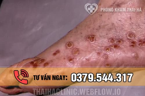 Bệnh Chlamydia