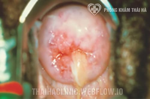 Viêm loét cổ tử cung có nguy hiểm không?