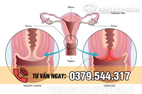 Bệnh viêm cổ tử cung