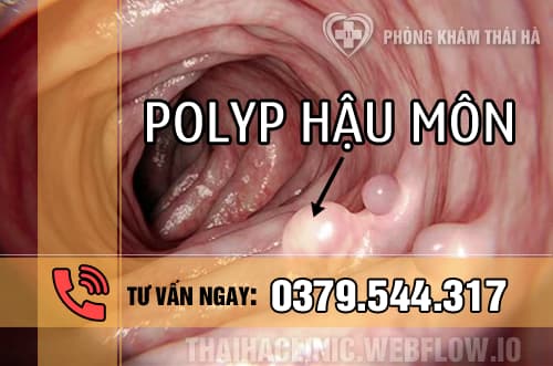 Bệnh Polyp hậu môn là gì và có nguy hiểm không