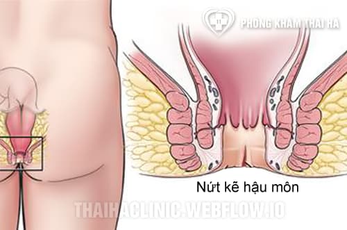 Bị nứt kẽ hậu môn phải làm sao?