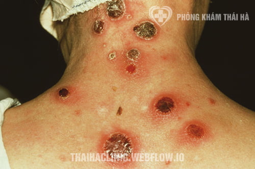 Giai đoạn phát triển của bệnh giang mai
