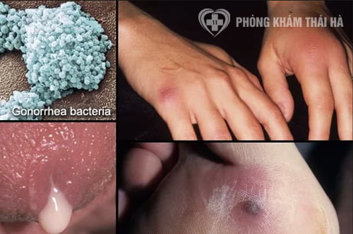 Dấu hiệu, triệu chứng nhận biết bệnh lậu