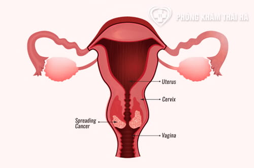 Bệnh ung thư cổ tử cung