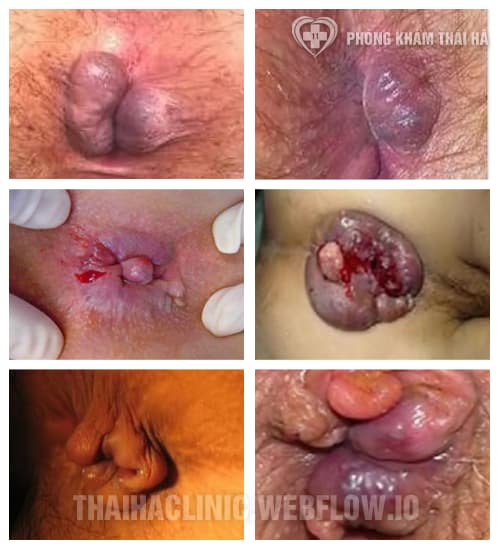 Một số hình ảnh bệnh lòi dom