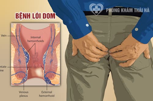 Bệnh lòi dom