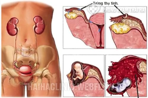 Thai ngoài tử cung
