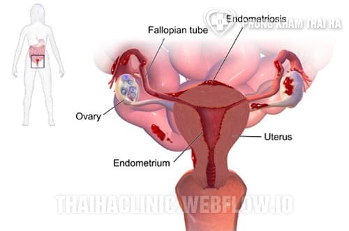Lạc nội mạc tử cung