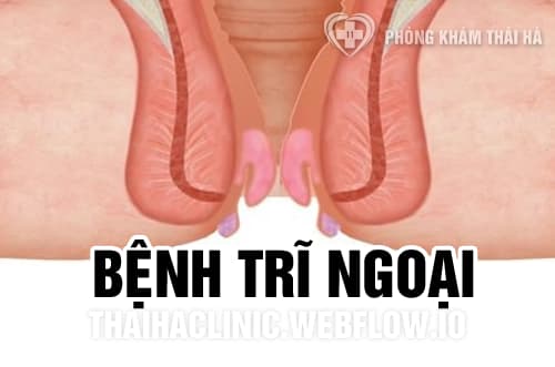 Bệnh trĩ ngoại độ 1