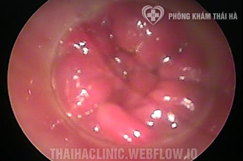 Hinh anh tri noi do 3 sa bui tri