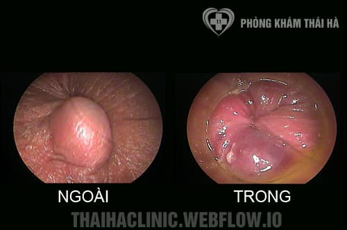 Hình ảnh bệnh trĩ hỗn hợp