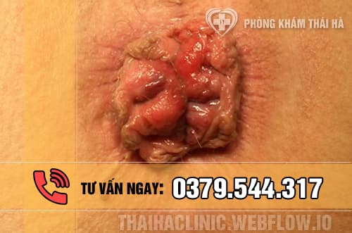 Hình ảnh bị bệnh trĩ