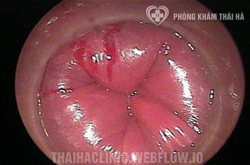 Hinh anh tri noi do 4 sung to viem nhiem