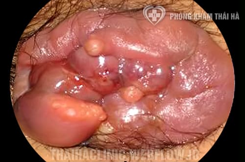 Hình ảnh trĩ ngoại độ 4