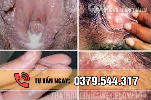 Hình ảnh bệnh lậu ở nữ giới