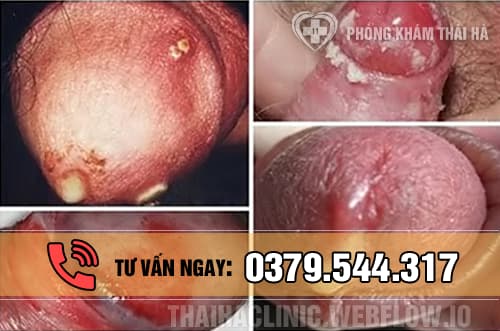 Hình ảnh bệnh lậu ở nam giới