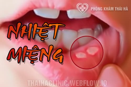 Nhiệt miệng (lở miệng)