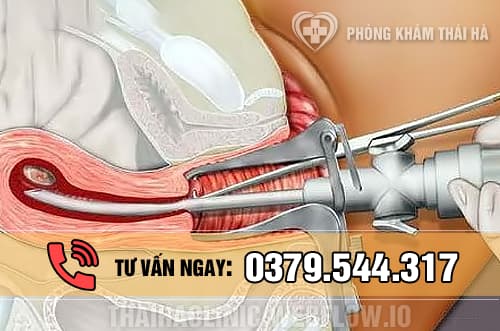 Phương pháp hút thai chân không