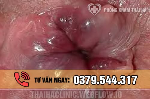 Trĩ ngoại độ 2