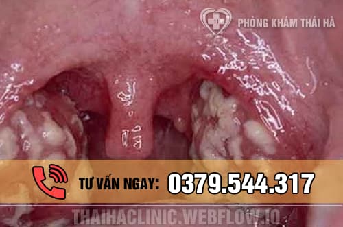 Triệu chứng bệnh lậu ở miệng