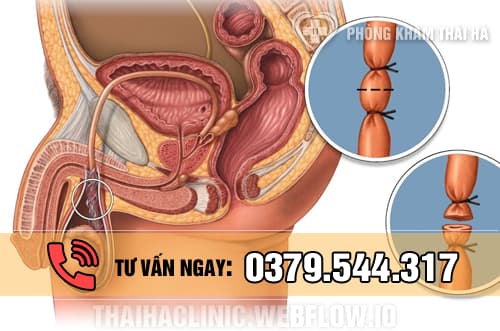 Cách triệt sản ở nam giới