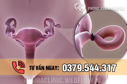 Cách triệt sản ở nữ giới