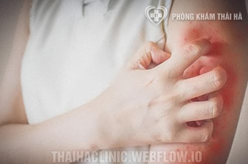 Sốt phát ban ở người lớn