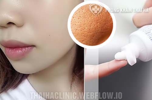 Cách trị mụn đầu đen bằng kem đánh răng an toàn - hiệu quả tại nhà