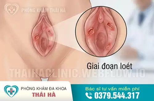 Hình ảnh mụn rộp sinh dục ở nữ giới giai đoạn loét