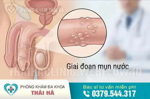 Hình ảnh mụn rộp sinh dục ở nam giới giai đoạn mụn nước
