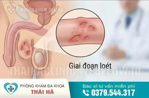 Hình ảnh mụn rộp sinh dục ở nam giới giai đoạn loét