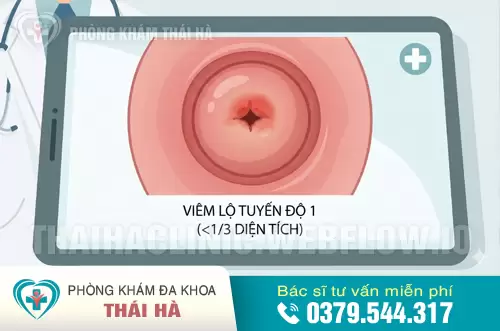 Hình ảnh viêm lộ tuyến cổ tử cung độ 1: Diện tích tổn thương chiếm dưới 1/3 diện tích bề mặt cổ tử cung