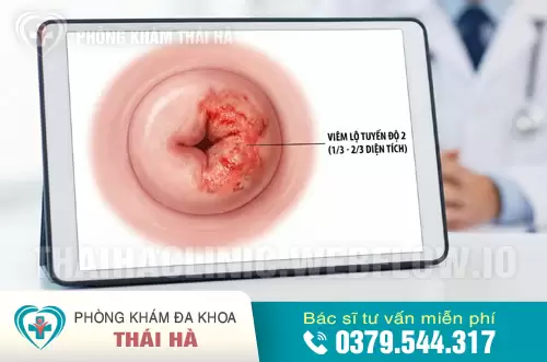 Hình ảnh viêm lộ tuyến cổ tử cung độ 2: Diện tích tổn thương chiếm từ 1/3 - 2/3 diện tích bề mặt cổ tử cung