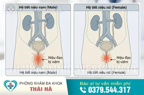 Hình ảnh niệu đạo bị viêm nhiễm ở nam và nữ