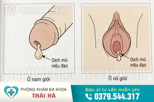 Hình ảnh niệu đạo chảy mủ ở nam và nữ giới