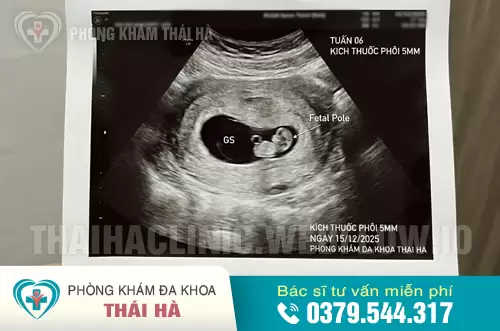 Hình ảnh siêu âm thai 6 tuần tại Phòng khám Thái Hà