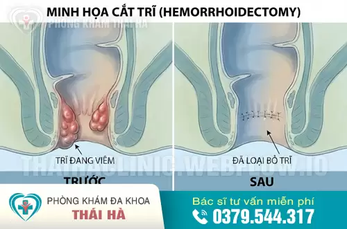 Hinh anh truoc va sau khi cat tri bang may PPH & HCPT