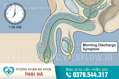 Lỗ sáo sưng đỏ và chảy mủ xanh đặc trưng.