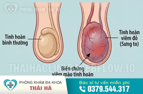 Biến chứng viêm mào tinh hoàn do lậu cầu khuẩn