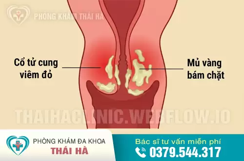 Cổ tử cung bị vi khuẩn lậu tấn công gây viêm mủ nghiêm trọng.